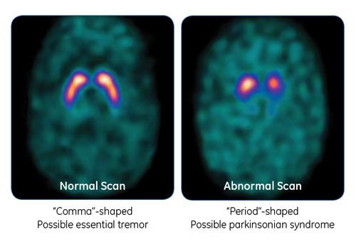 What is DaTscan should I one? American Parkinson Disease Association