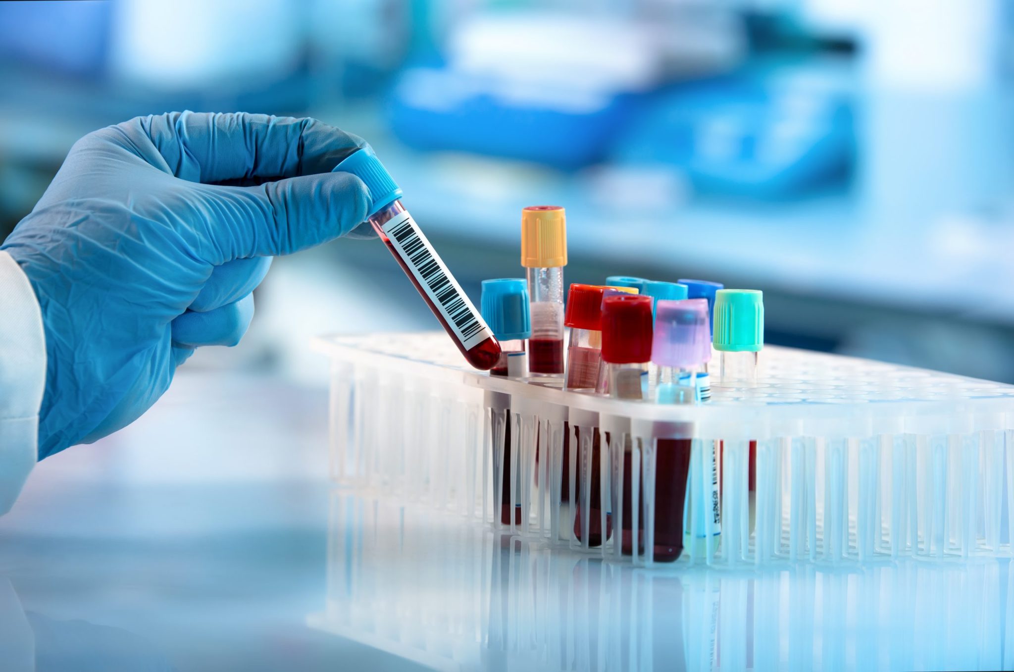 New Laboratory Tests For Parkinson’s Disease 