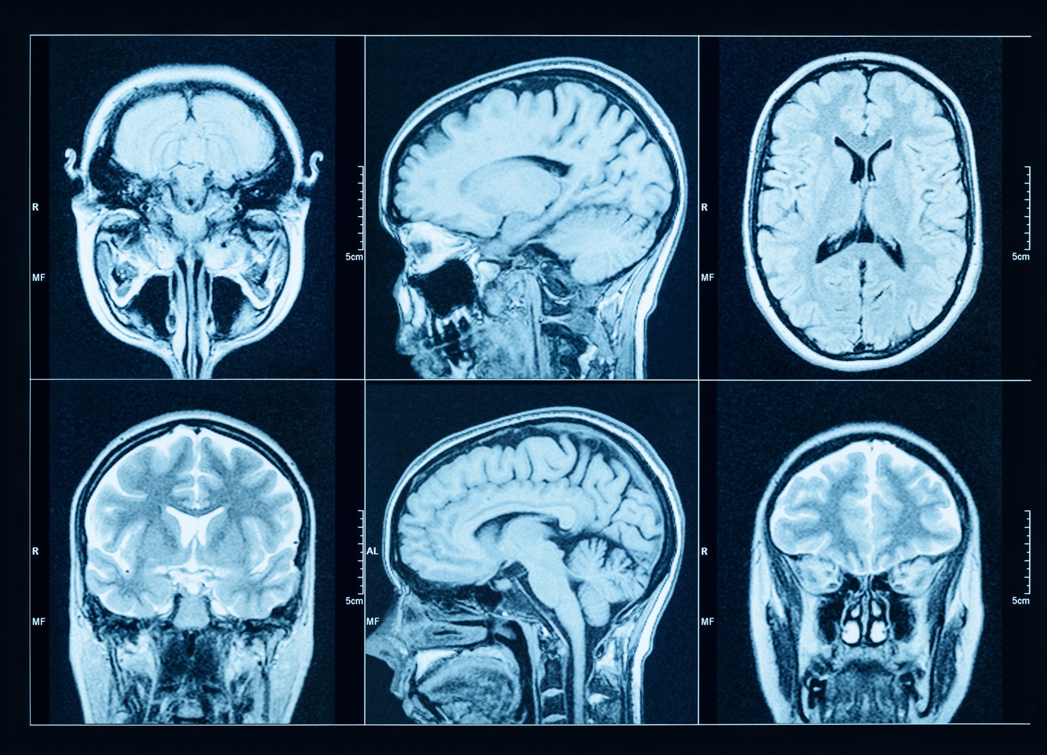 Brain Imaging for Parkinson’s Disease
